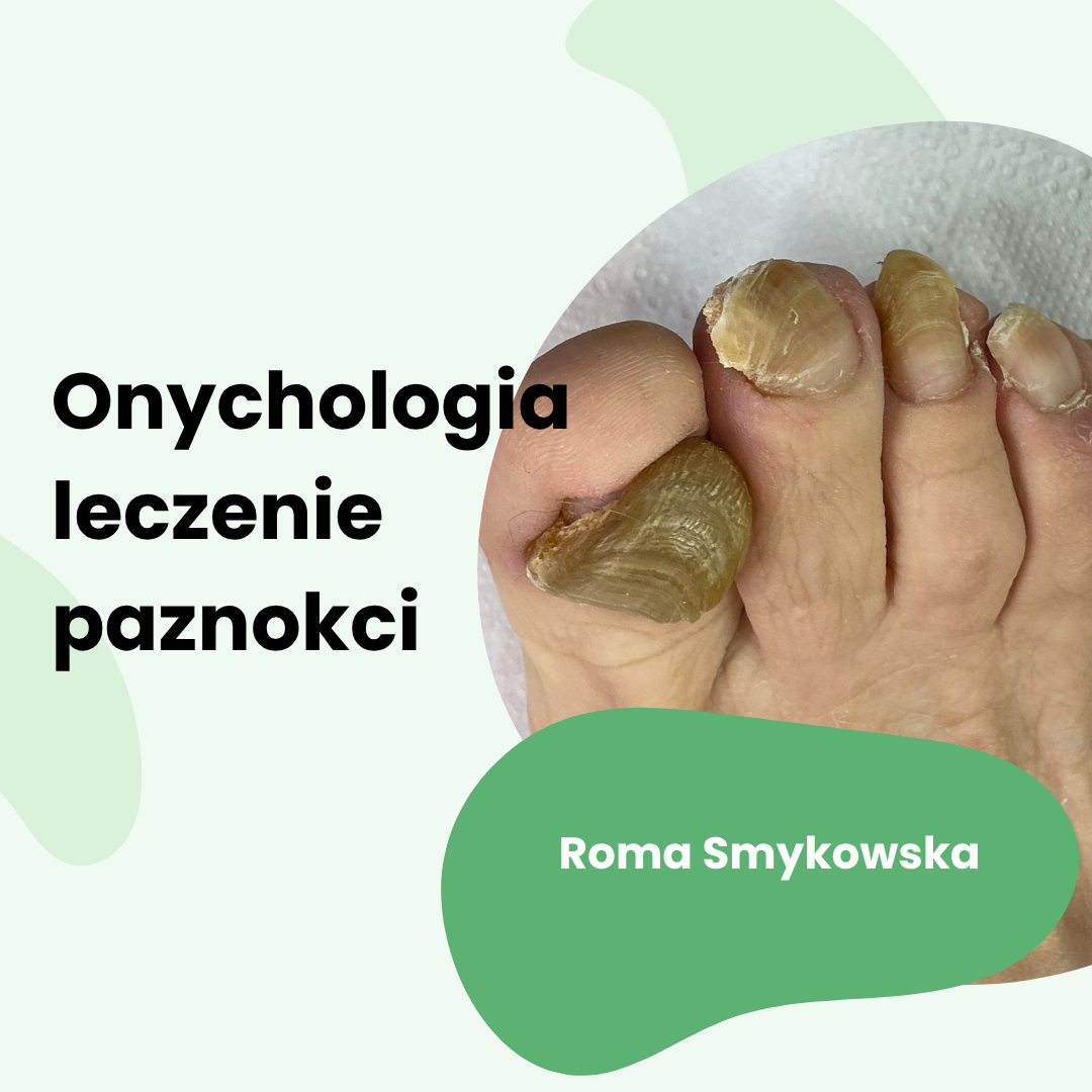 Szkolenie podologiczne onychologia - diagnostyka, profilaktyka i leczenie paznokci